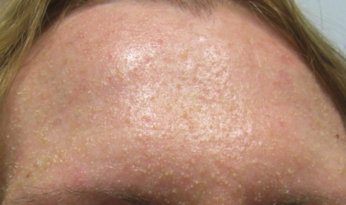 Retention hyperkeratosis is caused by stress