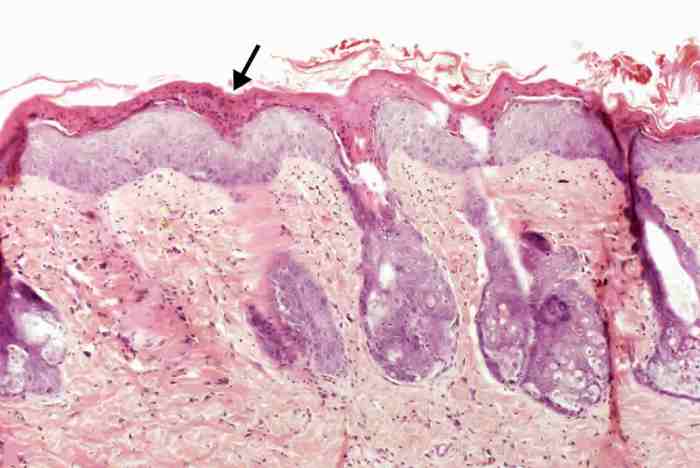 Hyperkeratosis retention severe susac syndrome occurring figure